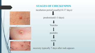 Chicken pox(masurika).pptx chicken pox pp | PPTX