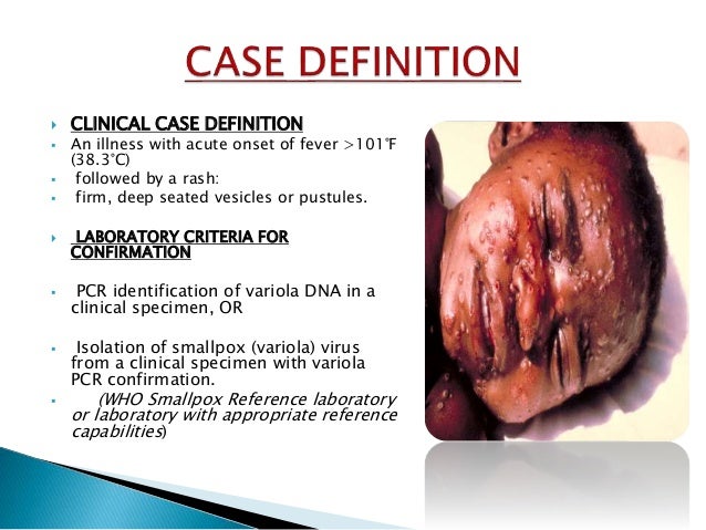 chicken pox medical term