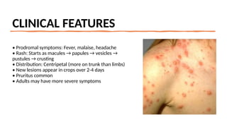 powerpoint on CHICKEN POX(Varicella).pptx