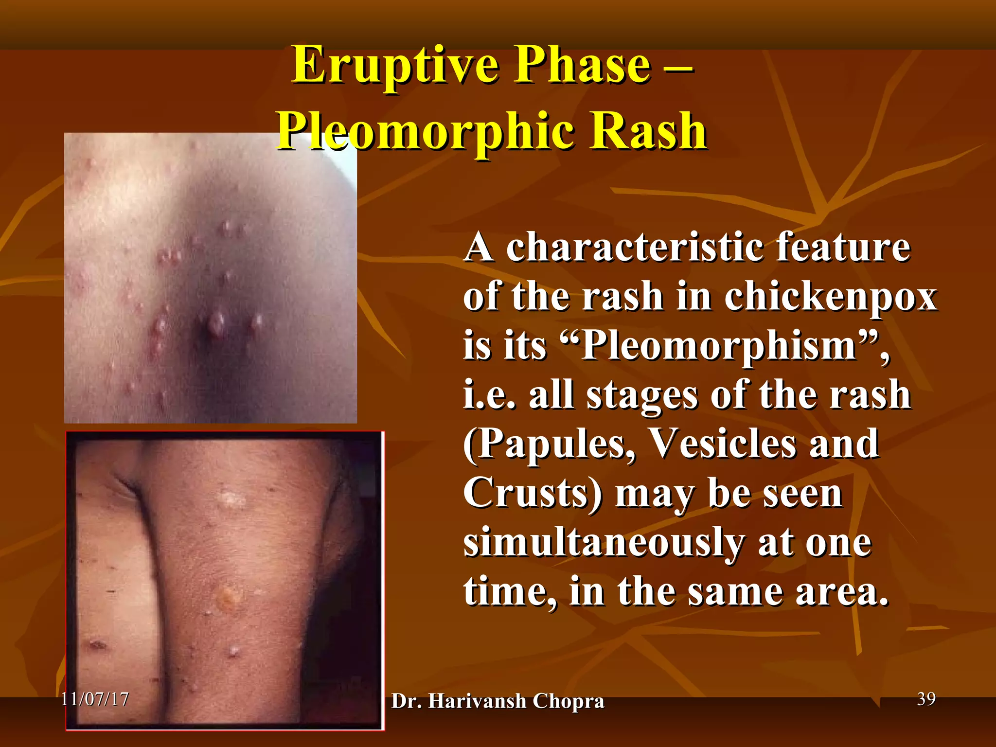 Chickenpox (varicella) dr harivansh chopra | PPT
