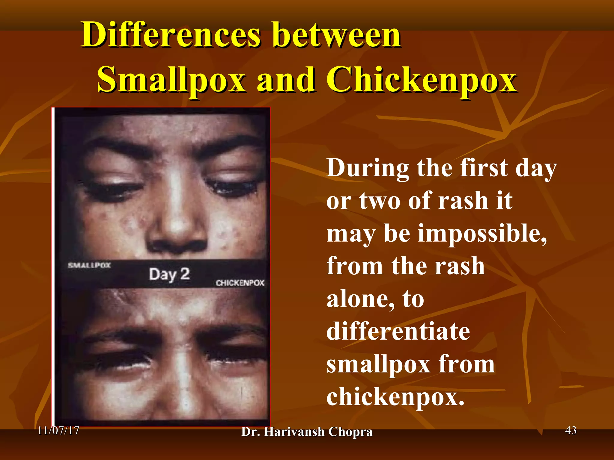 Chickenpox Doctor Chickenpox (varicella) dr harivansh chopra | PPT