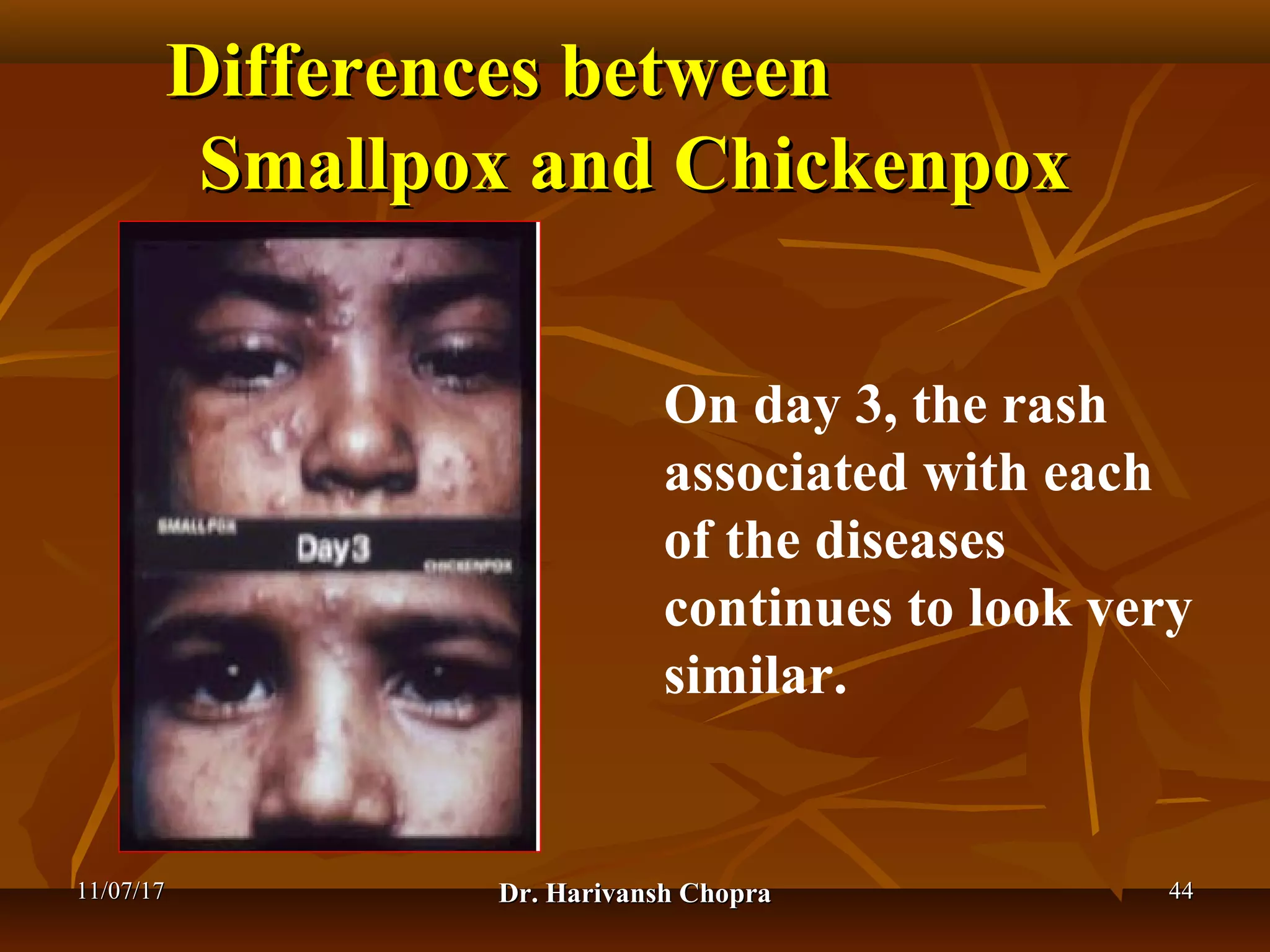 Chickenpox Doctor Chickenpox (varicella) dr harivansh chopra | PPT