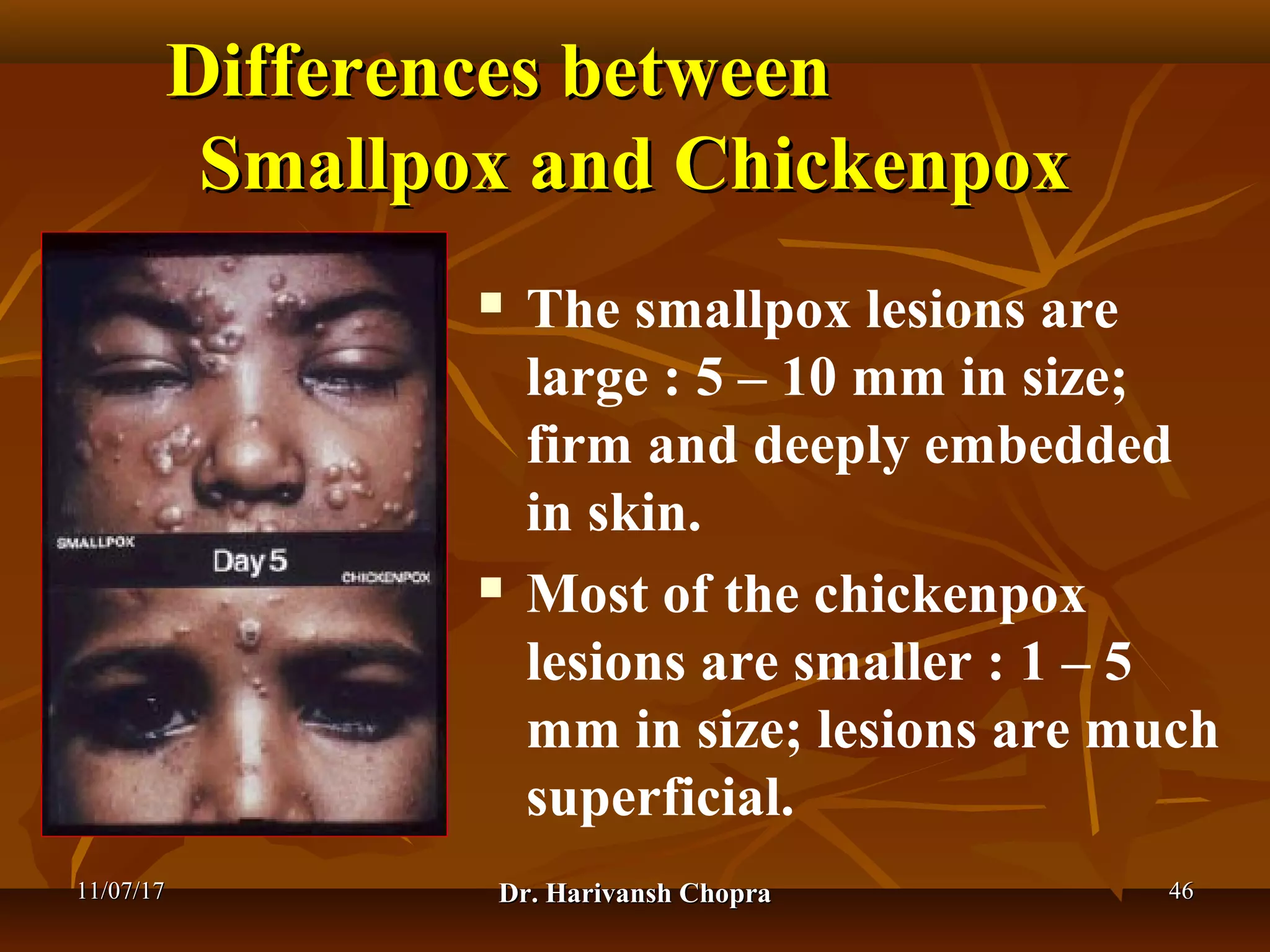 Chickenpox Doctor Chickenpox (varicella) dr harivansh chopra | PPT