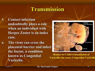 Chickenpox (varicella) dr harivansh chopra | PPT