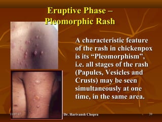 Chickenpox (varicella) dr harivansh chopra | PPT