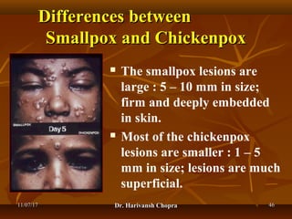 Chickenpox (varicella) dr harivansh chopra | PPT