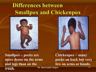 Chickenpox (varicella) dr harivansh chopra | PPT
