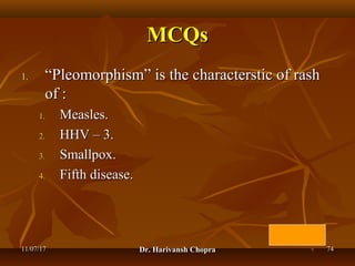 Chickenpox (varicella) dr harivansh chopra | PPT