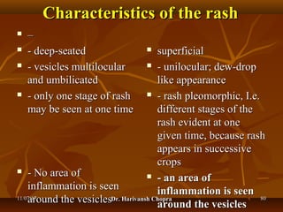 Chickenpox (varicella) dr harivansh chopra | PPT