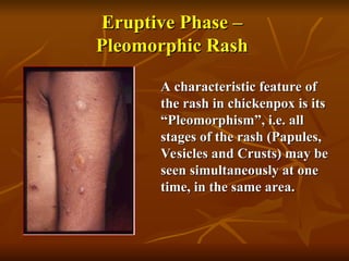 Chickenpox (Varicella) Infection and Its Clinical Implications | PPT