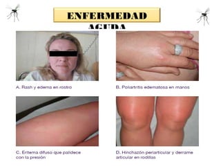 ENFERMEDAD
AGUDA
Fuente: Preparación y Respuesta ante la Eventual Introducción del Virus Chikungunya en las Américas, OPS,
 