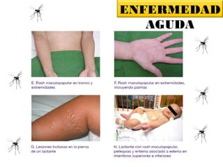 ENFERMEDAD
AGUDA
Fuente: Preparación y Respuesta ante la Eventual Introducción del Virus Chikungunya en las Américas, OPS,
 