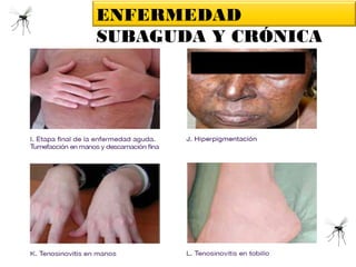 ENFERMEDAD
SUBAGUDA Y CRÓNICA
Fuente: Preparación y Respuesta ante la Eventual Introducción del Virus Chikungunya en las Américas, OPS,
 