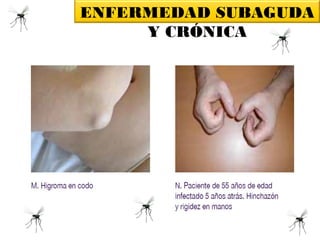ENFERMEDAD SUBAGUDA
Y CRÓNICA
Fuente: Preparación y Respuesta ante la Eventual Introducción del Virus Chikungunya en las Américas, OPS,
 