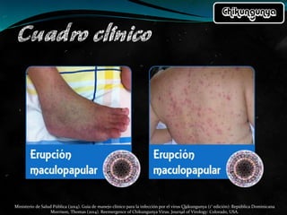 Ministerio de Salud Pública (2014). Guía de manejo clínico para la infección por el virus Chikungunya (1° edición): República Dominicana
Morrison, Thomas (2014). Reemergence of Chikungunya Virus. Journal of Virology: Colorado, USA.
 