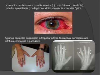 Y cambios oculares como uveitis anterior (ojo rojo doloroso, fotofobia),
retinitis, epiescleritis (con lagrimeo, dolor y fotofobia.), neuritis óptica,
Algunos pacientes desarrollan artropatía/ artritis destructiva, semejante a la
artritis reumatoidea o psoriásica.
 