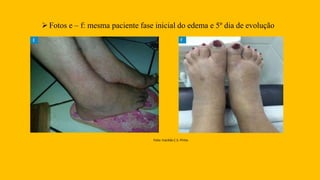 Fotos e – f: mesma paciente fase inicial do edema e 5º dia de evolução
Foto: Iracilda C.S. Pinto.
 