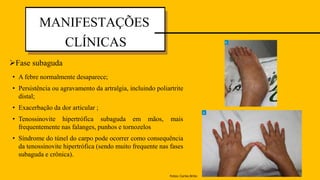 • A febre normalmente desaparece;
• Persistência ou agravamento da artralgia, incluindo poliartrite
distal;
• Exacerbação da dor articular ;
• Tenossinovite hipertrófica subaguda em mãos, mais
frequentemente nas falanges, punhos e tornozelos
• Síndrome do túnel do carpo pode ocorrer como consequência
da tenossinovite hipertrófica (sendo muito frequente nas fases
subaguda e crônica). febre
MANIFESTAÇÕES
CLÍNICAS
Fase subaguda
Fotos: Carlos Brito
 