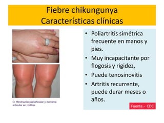 Fiebre chikungunya
Características clínicas
• Poliartritis simétrica
frecuente en manos y
pies.
• Muy incapacitante por
flogosis y rigidez,
• Puede tenosinovitis
• Artritis recurrente,
puede durar meses o
años.
Fuente.- CDC
 