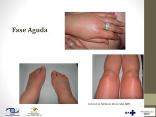 Simon et al. Medicine, 86 (3), May 2007
Fase Aguda
 