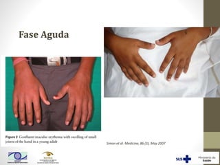 Simon et al. Medicine, 86 (3), May 2007
Fase Aguda
 