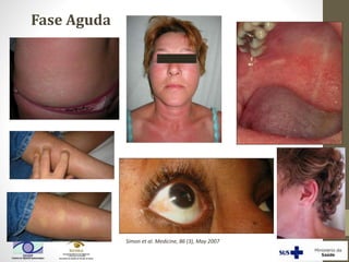 Simon et al. Medicine, 86 (3), May 2007
Fase Aguda
 