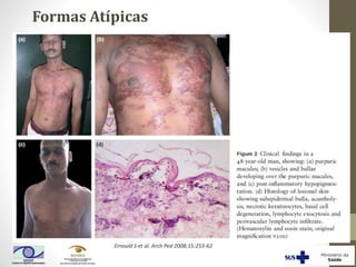Formas Atípicas
Ernould S et al. Arch Ped 2008;15:253-62
 