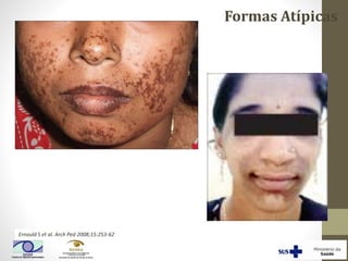 Formas Atípicas
Ernould S et al. Arch Ped 2008;15:253-62
 