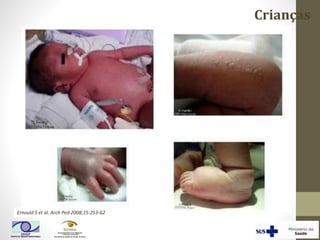 Crianças
Ernould S et al. Arch Ped 2008;15:253-62
 