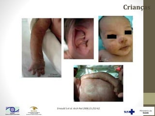 Crianças
Ernould S et al. Arch Ped 2008;15:253-62
 