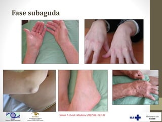 Simon F et coll. Medicine 2007;86: 123-37
Fase subaguda
 