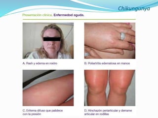 Chikungunya
 