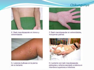 Chikungunya
 