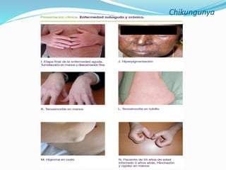Chikungunya
 