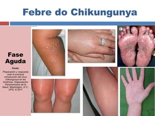 Febre do Chikungunya 
Fase 
Aguda 
Fonte: 
Preparación y respuesta 
ante la eventual 
introducción del virus 
chikungunya en las 
Américas. Organización 
Panamericana de la 
Salud. Washington, D.C.: 
OPS, © 2011 
 