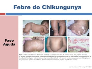 Febre do Chikungunya 
Fase 
Aguda 
 