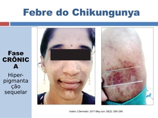 Febre do Chikungunya 
Fase 
CRÔNIC 
A 
Hiper-pigmanta 
ção 
sequelar 
Indian J Dermatol. 2011 May-Jun; 56(3): 290–294. 
 