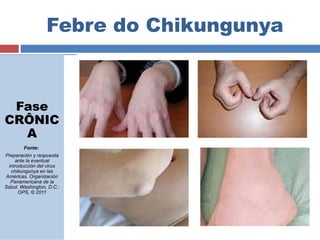 Febre do Chikungunya 
Fase 
CRÔNIC 
A 
Fonte: 
Preparación y respuesta 
ante la eventual 
introducción del virus 
chikungunya en las 
Américas. Organización 
Panamericana de la 
Salud. Washington, D.C.: 
OPS, © 2011 
 