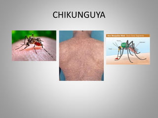 CHIKUNGUYA 
 