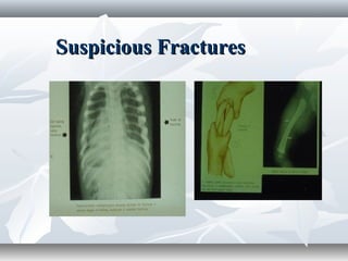 Suspicious FracturesSuspicious Fractures
 