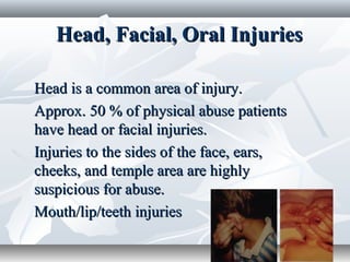 Head, Facial, Oral InjuriesHead, Facial, Oral Injuries
Head is a common area of injury.Head is a common area of injury.
Approx. 50 % of physical abuse patientsApprox. 50 % of physical abuse patients
have head or facial injuries.have head or facial injuries.
Injuries to the sides of the face, ears,Injuries to the sides of the face, ears,
cheeks, and temple area are highlycheeks, and temple area are highly
suspicious for abuse.suspicious for abuse.
Mouth/lip/teeth injuriesMouth/lip/teeth injuries
 