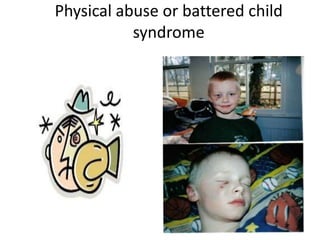 Physical abuse or battered child
syndrome
 