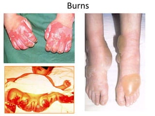 Burns
 