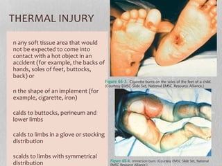 THERMAL INJURY
n any soft tissue area that would
not be expected to come into
contact with a hot object in an
accident (for example, the backs of
hands, soles of feet, buttocks,
back) or
n the shape of an implement (for
example, cigarette, iron)
calds to buttocks, perineum and
lower limbs
calds to limbs in a glove or stocking
distribution
scalds to limbs with symmetrical
distribution
 