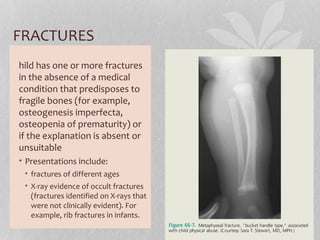 FRACTURES
hild has one or more fractures
in the absence of a medical
condition that predisposes to
fragile bones (for example,
osteogenesis imperfecta,
osteopenia of prematurity) or
if the explanation is absent or
unsuitable
• Presentations include:
• fractures of different ages
• X-ray evidence of occult fractures
(fractures identified on X-rays that
were not clinically evident). For
example, rib fractures in infants.
 