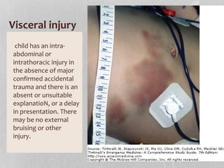 Visceral injury
child has an intra-
abdominal or
intrathoracic injury in
the absence of major
confirmed accidental
trauma and there is an
absent or unsuitable
explanatioN, or a delay
in presentation. There
may be no external
bruising or other
injury.
 