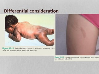 Differential consideration
 