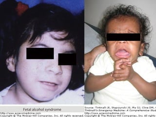 Fetal alcohol syndrome
 