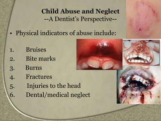 Child Abuse and Neglect
--A Dentist’s Perspective--
• Physical indicators of abuse include:
1. Bruises
2. Bite marks
3. Burns
4. Fractures
5. Injuries to the head
6. Dental/medical neglect
 