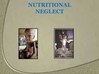 NUTRITIONAL
NEGLECT
 